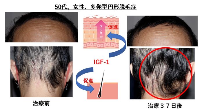 円形脱毛症　病院
